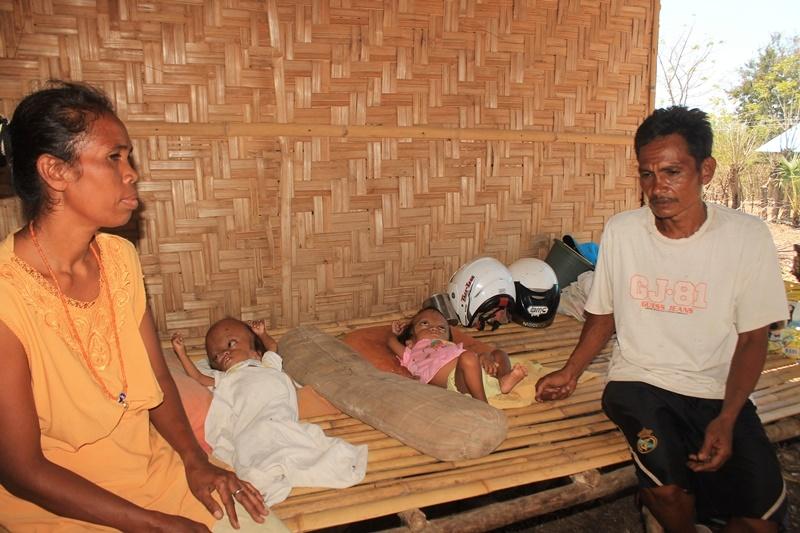 Telat Miliki Kartu Indonesia Sehat, Bayi Kembar  Hidrosefalus di NTT Memburuk