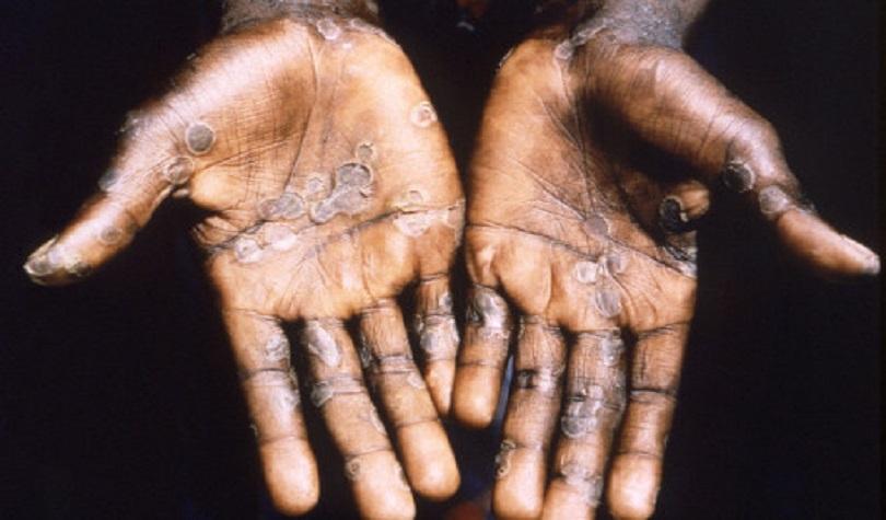 Telapak tangan pasien kasus cacar monyet di Republik Demokratik Kongo pada 1997. (Antara/Brian)